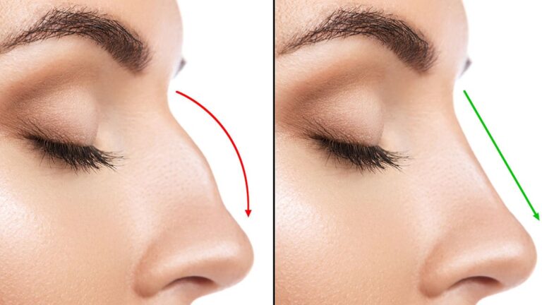 Récupération après une rhinoplastie et retour à la respiration normale